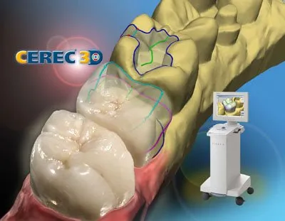 digital image of CEREC crowns with CEREC logo