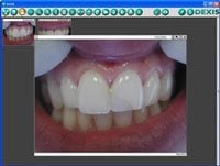 Photo of front teeth from an intraoral camera